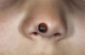 mole-nose-nevus